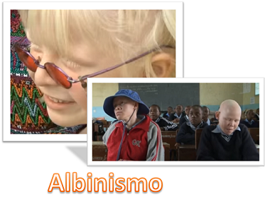 Albinismo